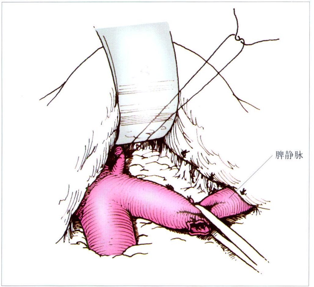 第二節(jié) 選擇性門-腔靜脈分流術(shù)